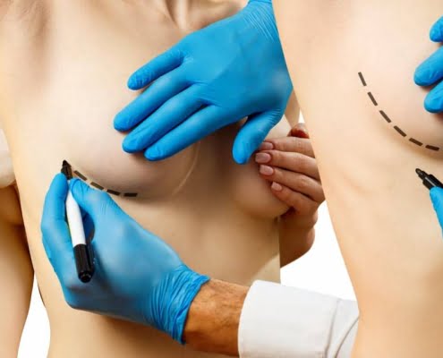 En quoi consiste l’intervention de réduction mammaire ?