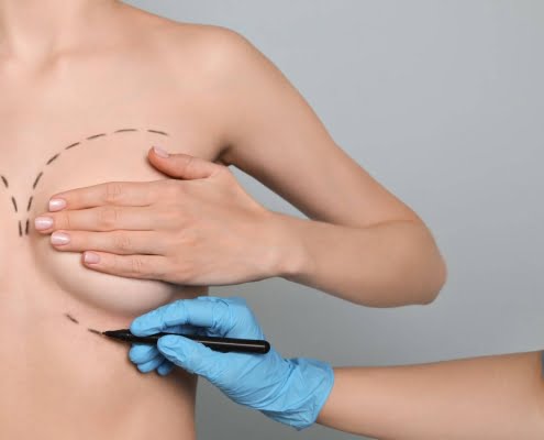 En quoi consiste l'augmentation mammaire avec pose d'implants pré pectoraux ou rétro pectoraux du Docteur Ankri à Marseille?